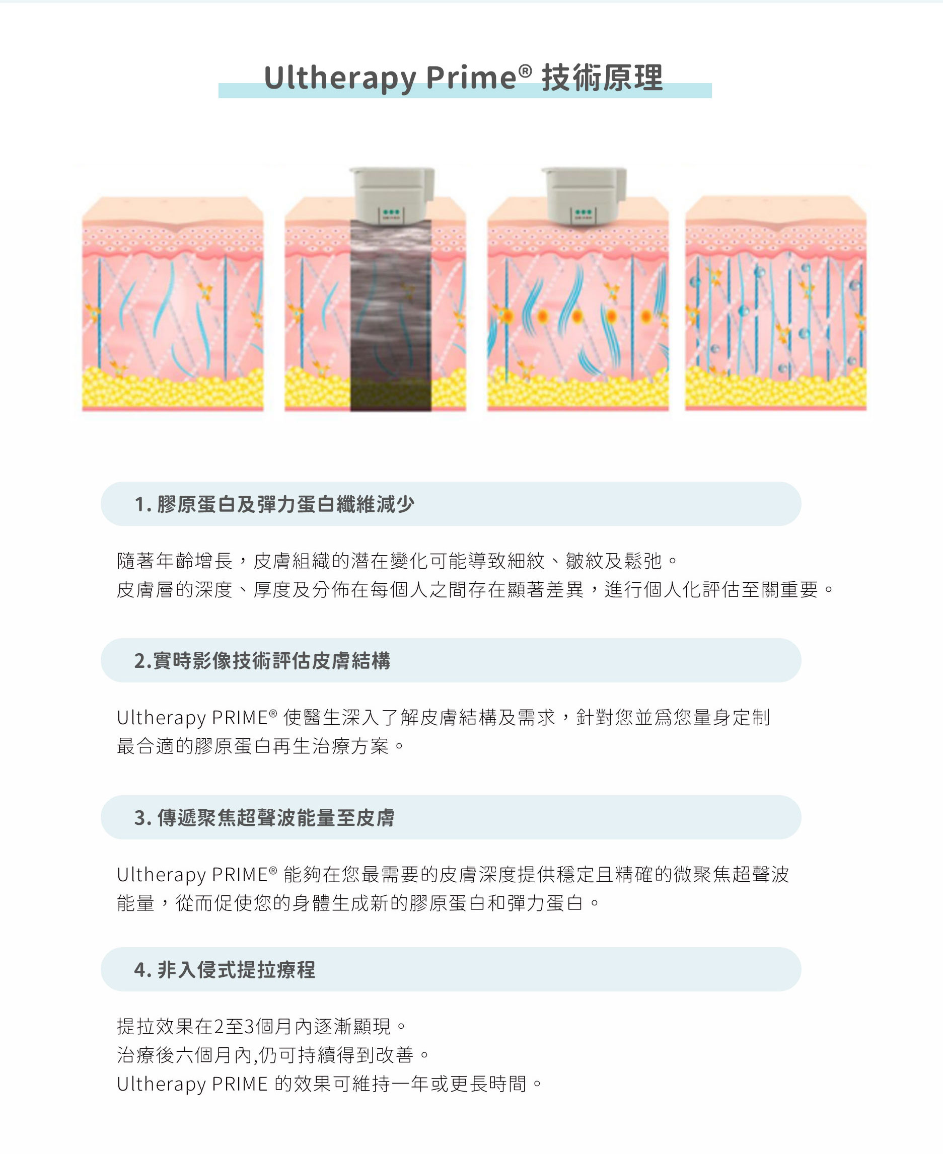 Ultherapy超聲刀面部提拉效果示意，緊致輪廓、改善法令紋與下頸線條
