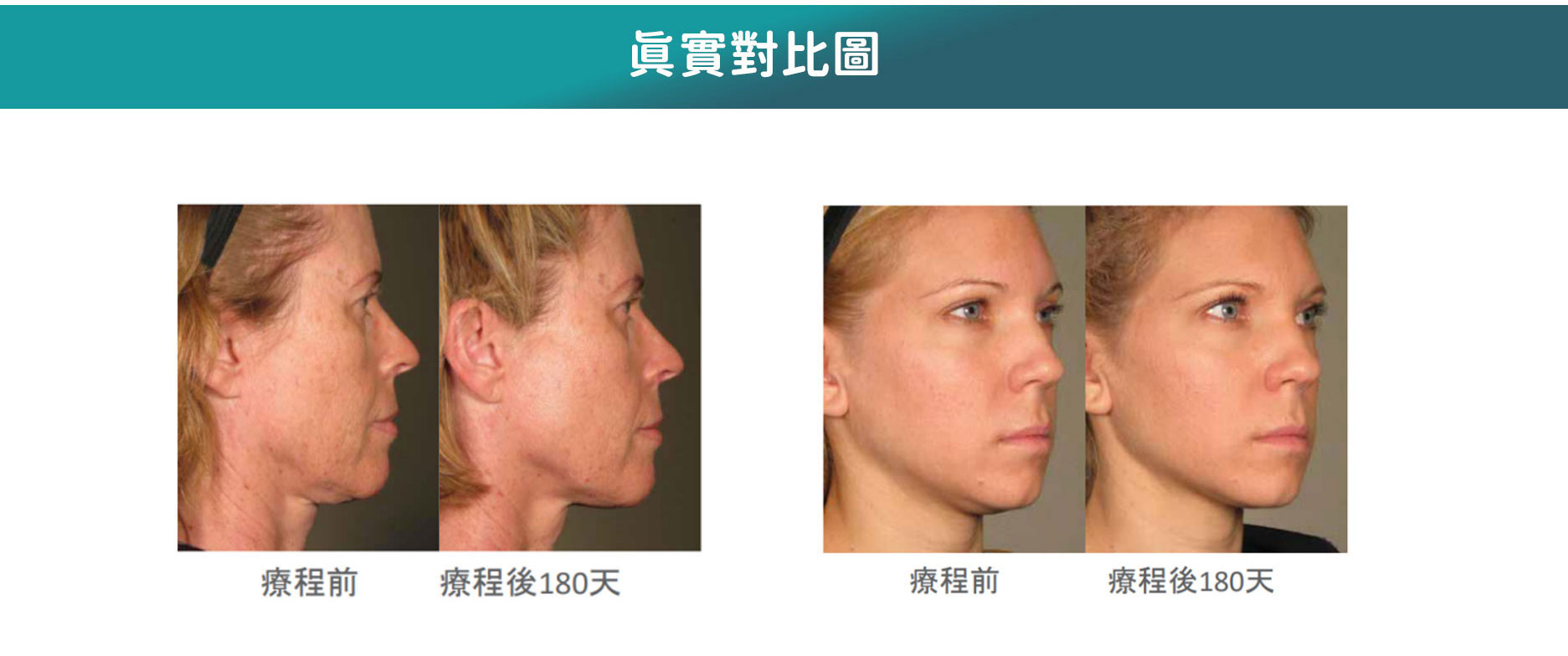 G2 Beauty Ultherapy客戶見證效果，音波拉提前後對比，肌膚緊致輪廓提升